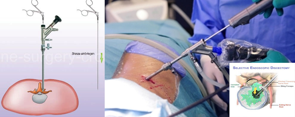 endoscopic-spine-surgery endoscopic-spine-surgery